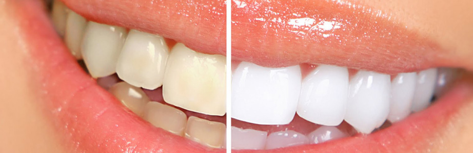 svájci fehér fogak anti aging